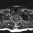 TOS Case Studies-Delayed Diagnosis of Thoracic Outlet Syndrome