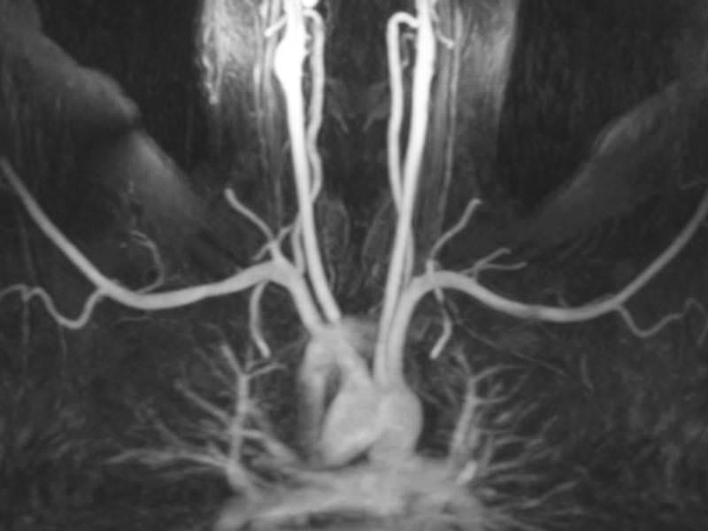 thoracic outlet syndrome mri